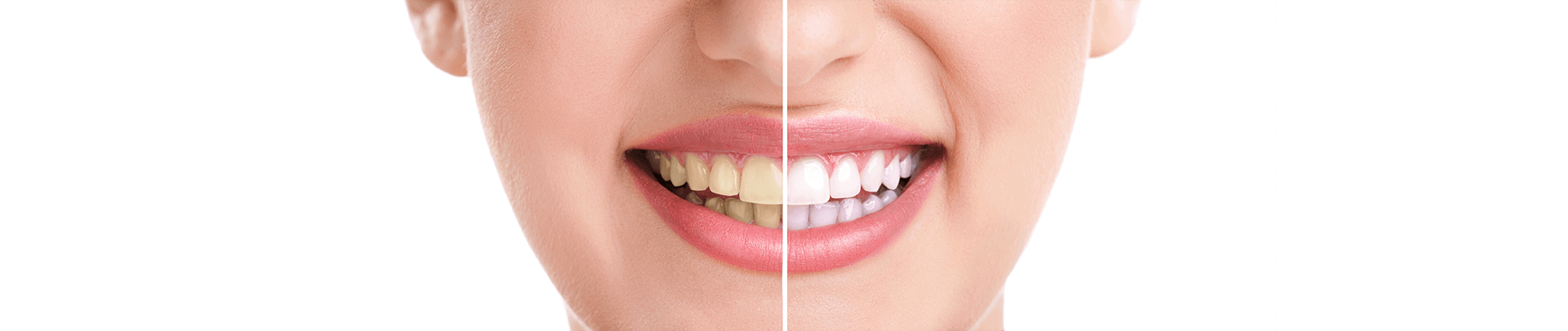 Teeth Whitening in Newark, California